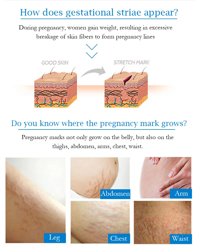 80 G Odstranjevanje Strij, Krema Proti Gubam Anti Aging Porodniškega Koža Popravila Odstranite Nosečnosti Brazgotine Zdravljenje Telesa, za Nego Kože
